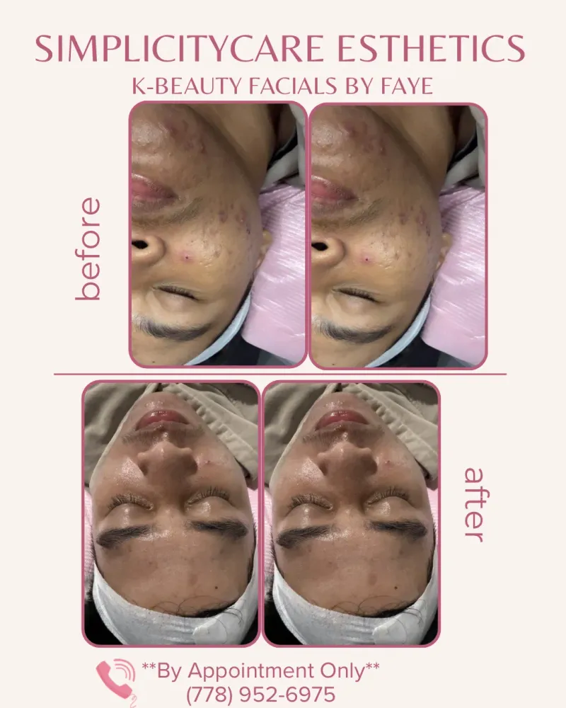 Acne Care Treatment