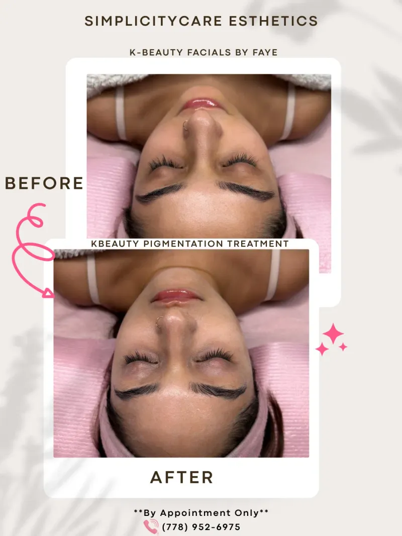 Pigmentation Microneedling/Nanoneedling
